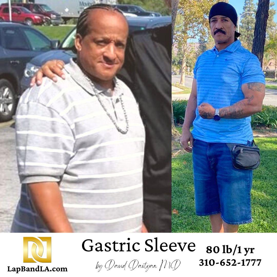LapBandLA.com Before and Afters 56659 gastric sleeve before and after
