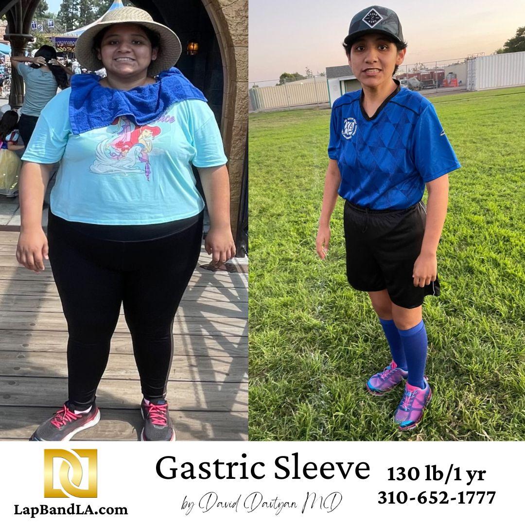 LapBandLA.com Before and Afters gastric sleeve before and after