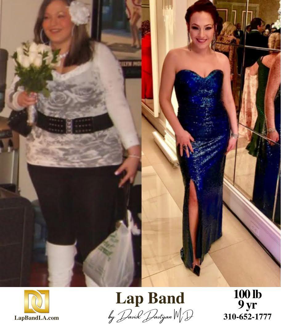 BB4 min lapband surgery beverly hills