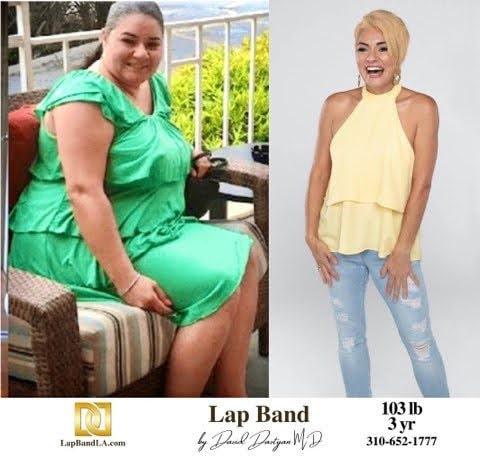 Bariatric Surgery Before After Weight Loss Lap Band Gastric Sleeve Gastric Bypass Gastric Balloon 5 min gastric sleeve before and after