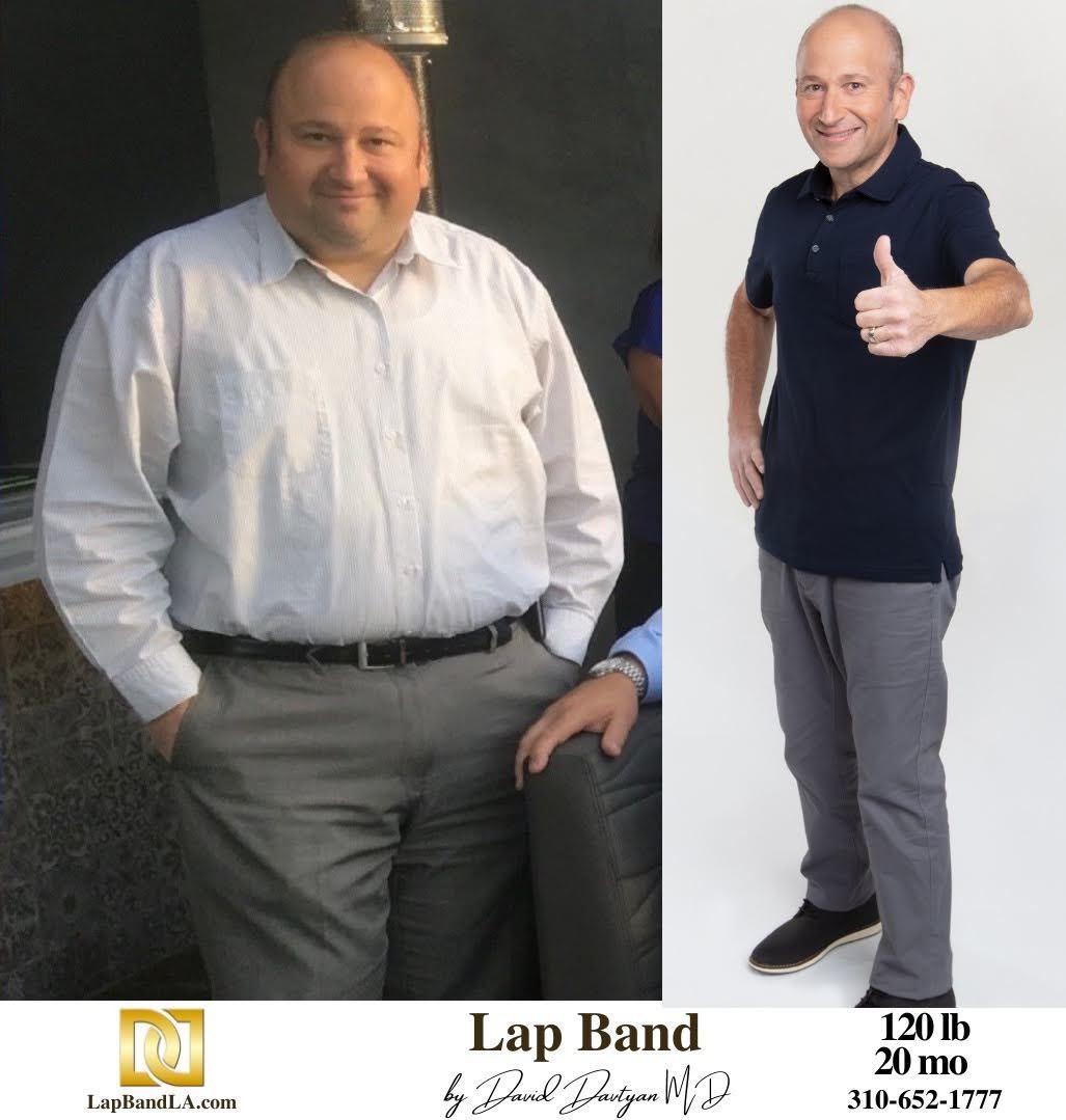 Bariatric Surgery Before After Weight Loss Lap Band Gastric Sleeve Gastric Bypass Gastric Balloon 9 min gastric sleeve before and after