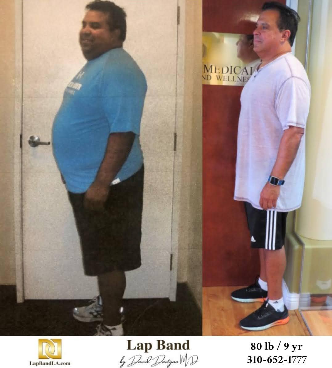 Before After Bariatric Surgery Photo Gastric Sleeve 1 min lapband surgery beverly hills