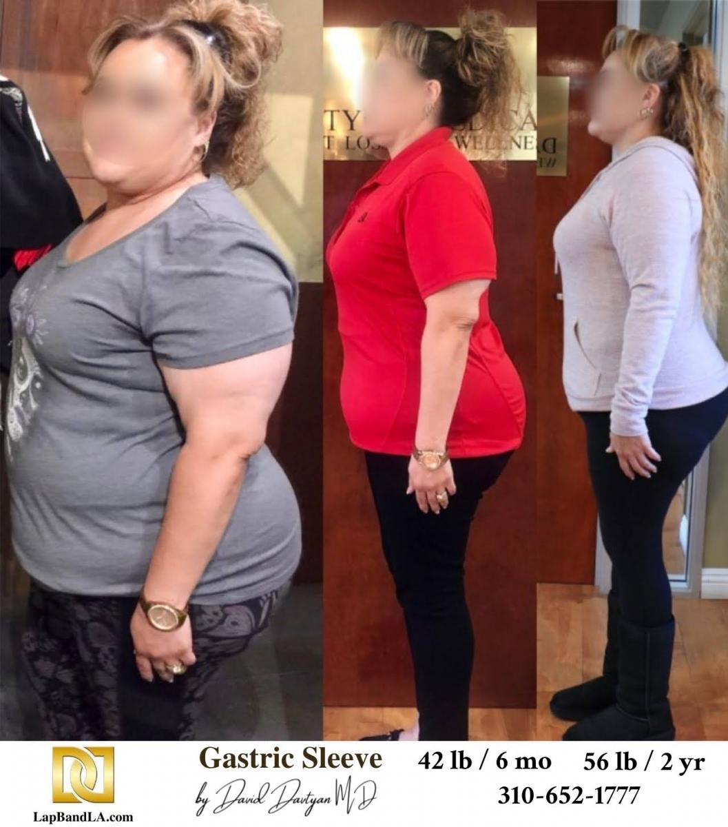 Before After Bariatric Surgery Photo Gastric Sleeve min lapband surgery rancho cucamonga