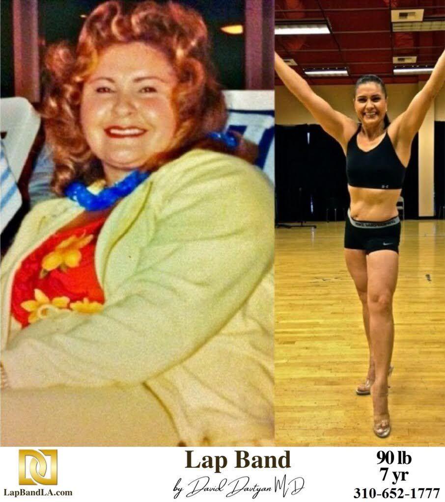Before and after weight loss surgery patient photo 11 min lapband surgery before and after