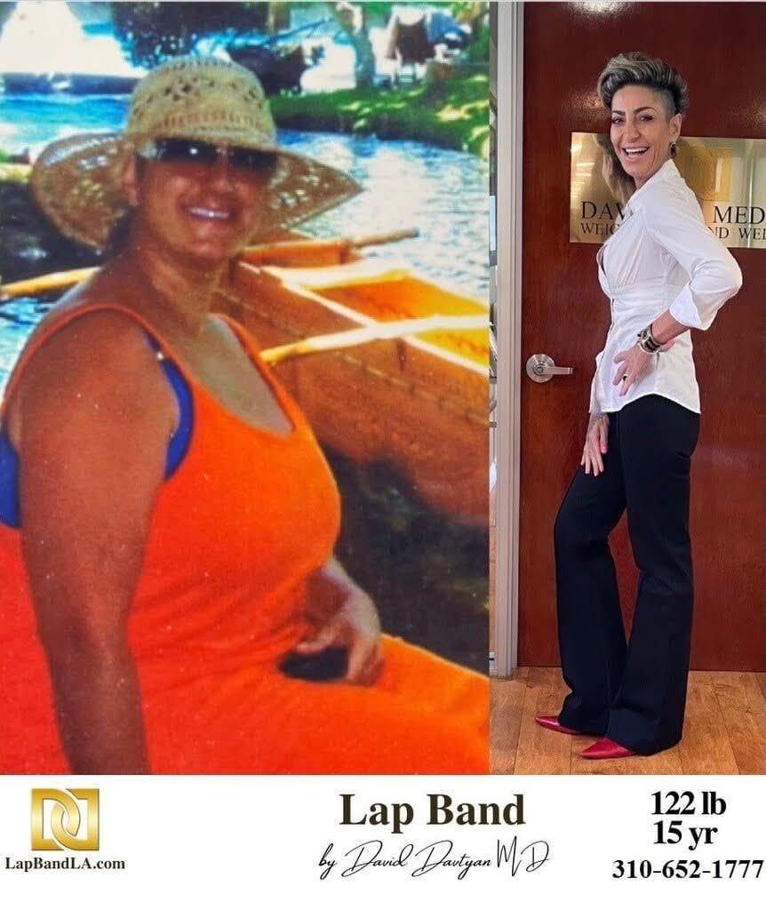 Before and after weight loss surgery patient photo 23 min lapband surgery before and after