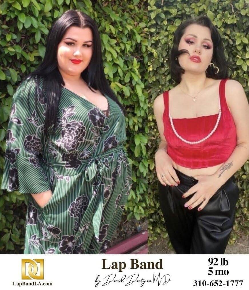 Before and after weight loss surgery patient photo 3 min lapband surgery before and after