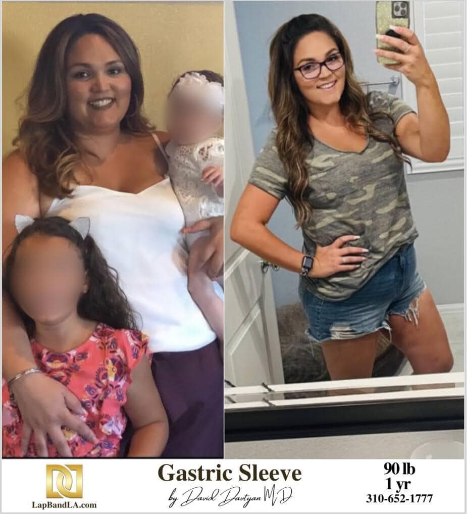 Lap Band Before After Bariatric Surgery Photo 1 11 min gastric sleeve before and after