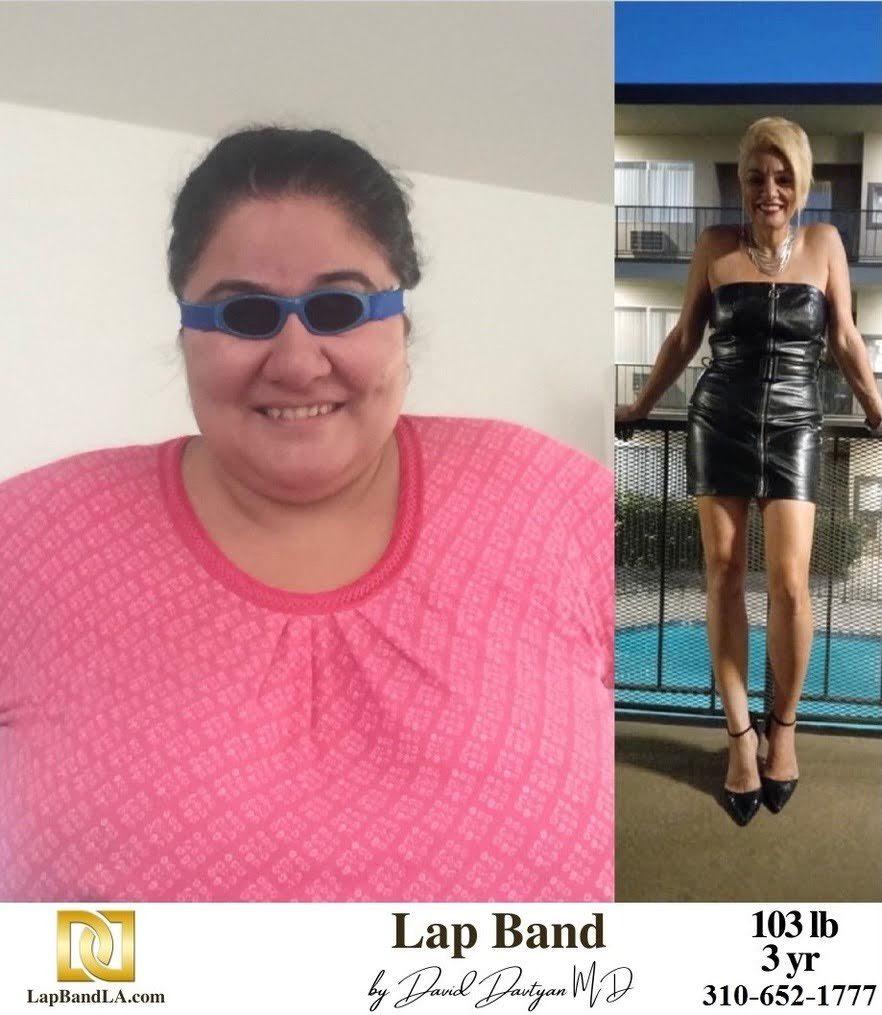 Lap Band Before After Bariatric Surgery Photo 1 19 min gastric sleeve before and after
