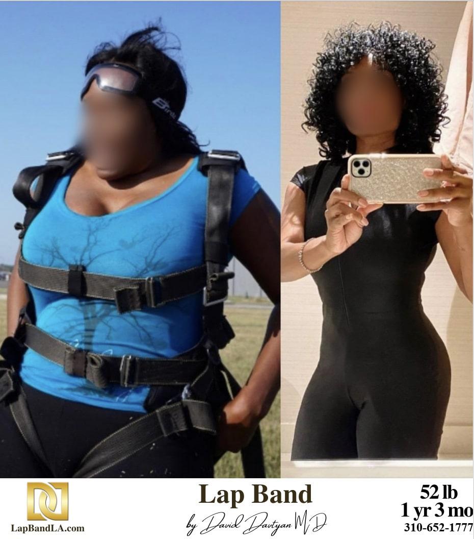 Lap Band Before After Bariatric Surgery Photo 1 3 min gastric sleeve before and after