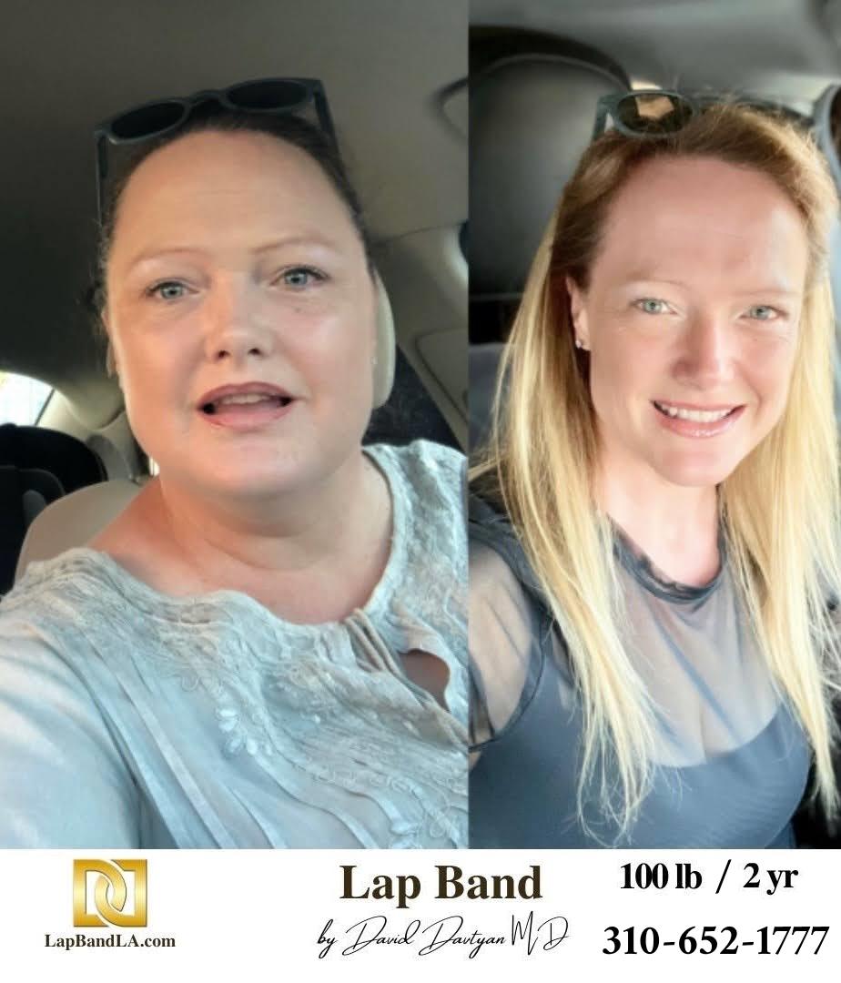 Lap Band Before After Bariatric Surgery Photo 1 32 lapband surgery before and after