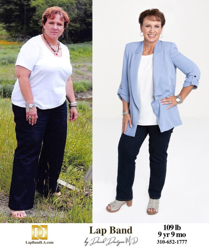 Lap Band Before After Bariatric Surgery Photo 1 48 min gastric sleeve before and after