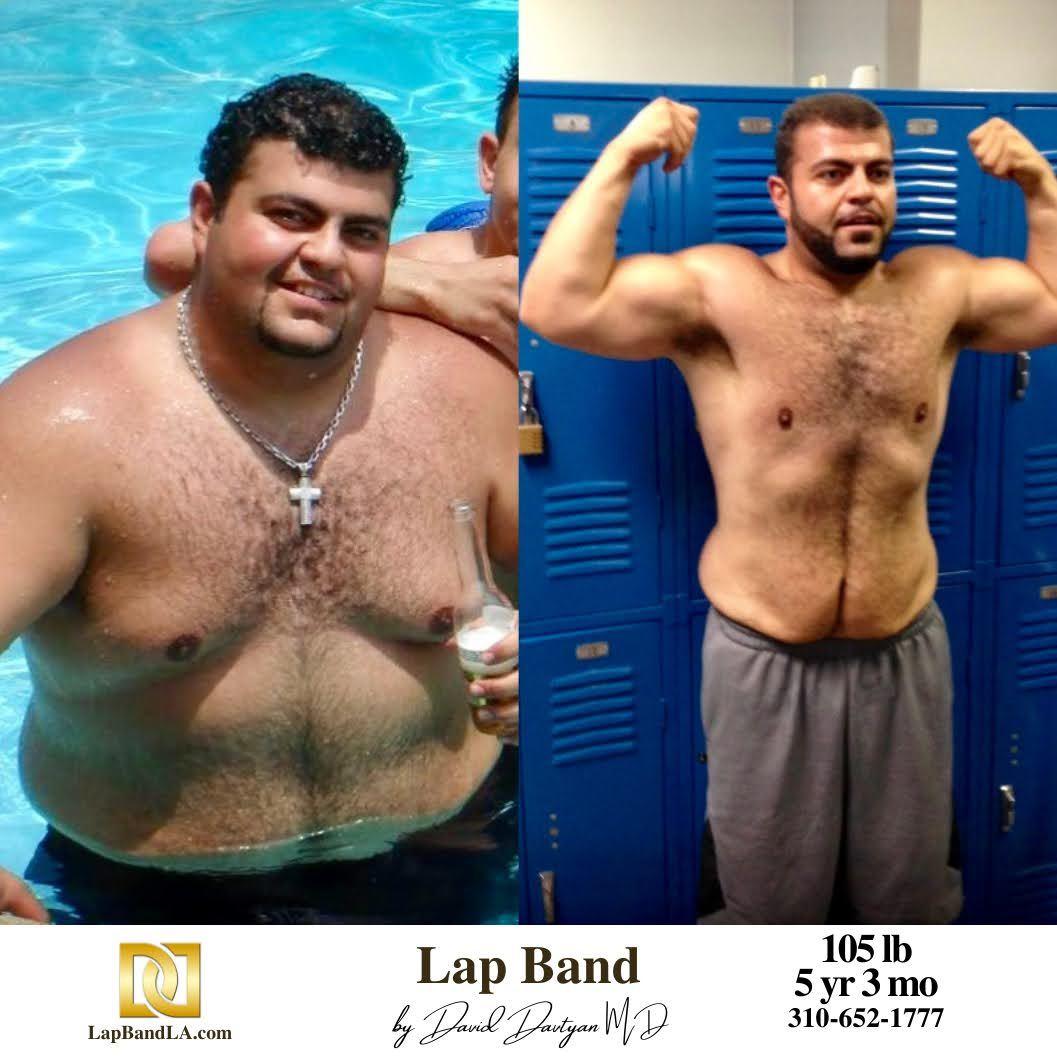 Lap Band Before After Bariatric Surgery Photo 1 min lapband surgery before and after