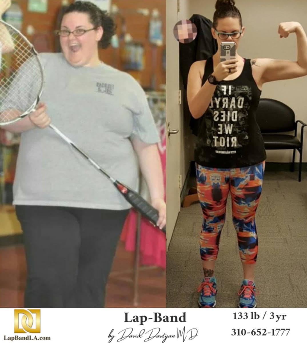 Lap Band Before After Bariatric Surgery Photo 4 min gastric sleeve before and after