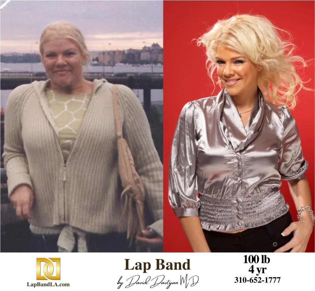 Lap Band Before After Bariatric Surgery Photo min 1 lapband surgery before and after
