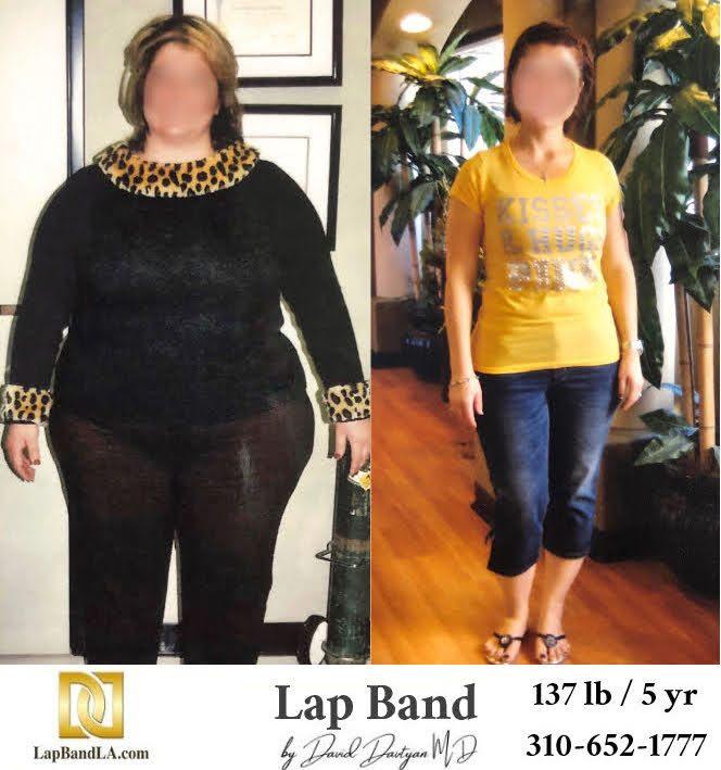 Lap Band Before After Bariatric Surgery Photo min lapband surgery before and after