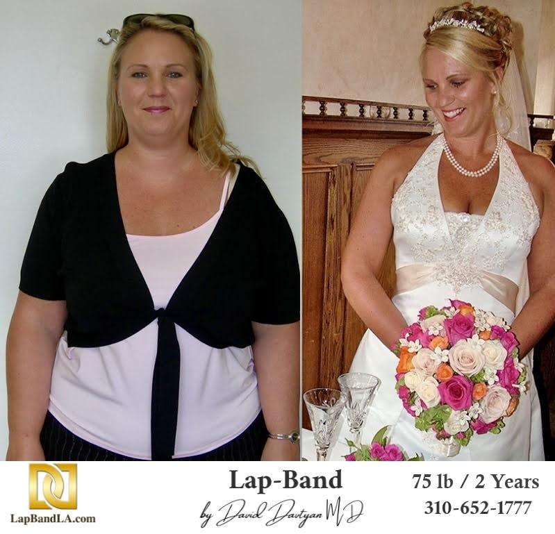 Lap Band Before And After min lapband surgery before and after