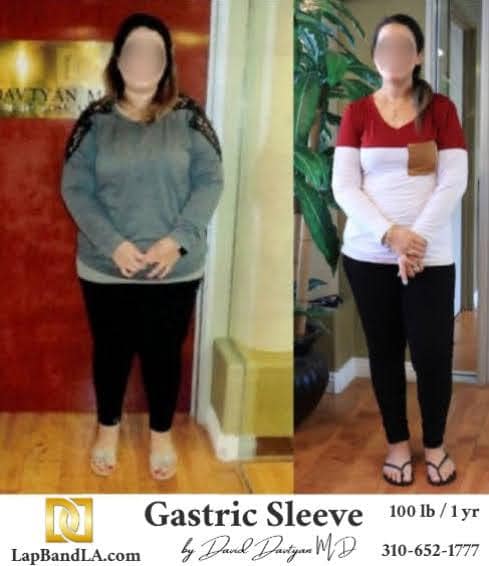Monica Gastric Sleeve min weight loss surgery beverly hills