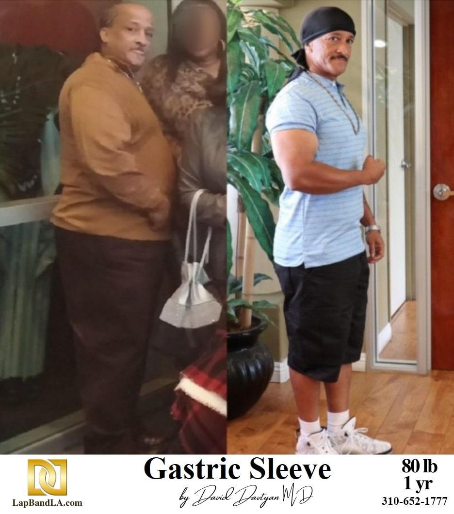 Weight Loss Surgery Bariatric Surgery Gastric Band Lap Band® Gastric Sleeve 2 min weight loss surgery