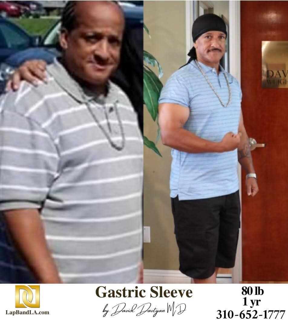 Weight Loss Surgery Bariatric Surgery Gastric Band Lap Band® Gastric Sleeve min weight loss surgery