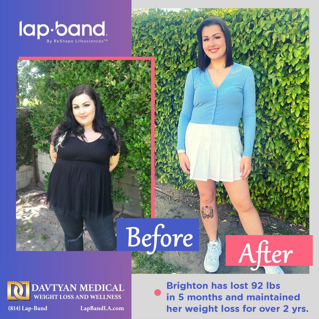 Brighton Before After Brighton before & after lap-band surgery with Weight Loss Surgery Center of LA