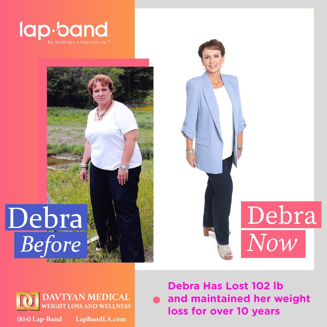 Debra Before After lapband surgery glendale