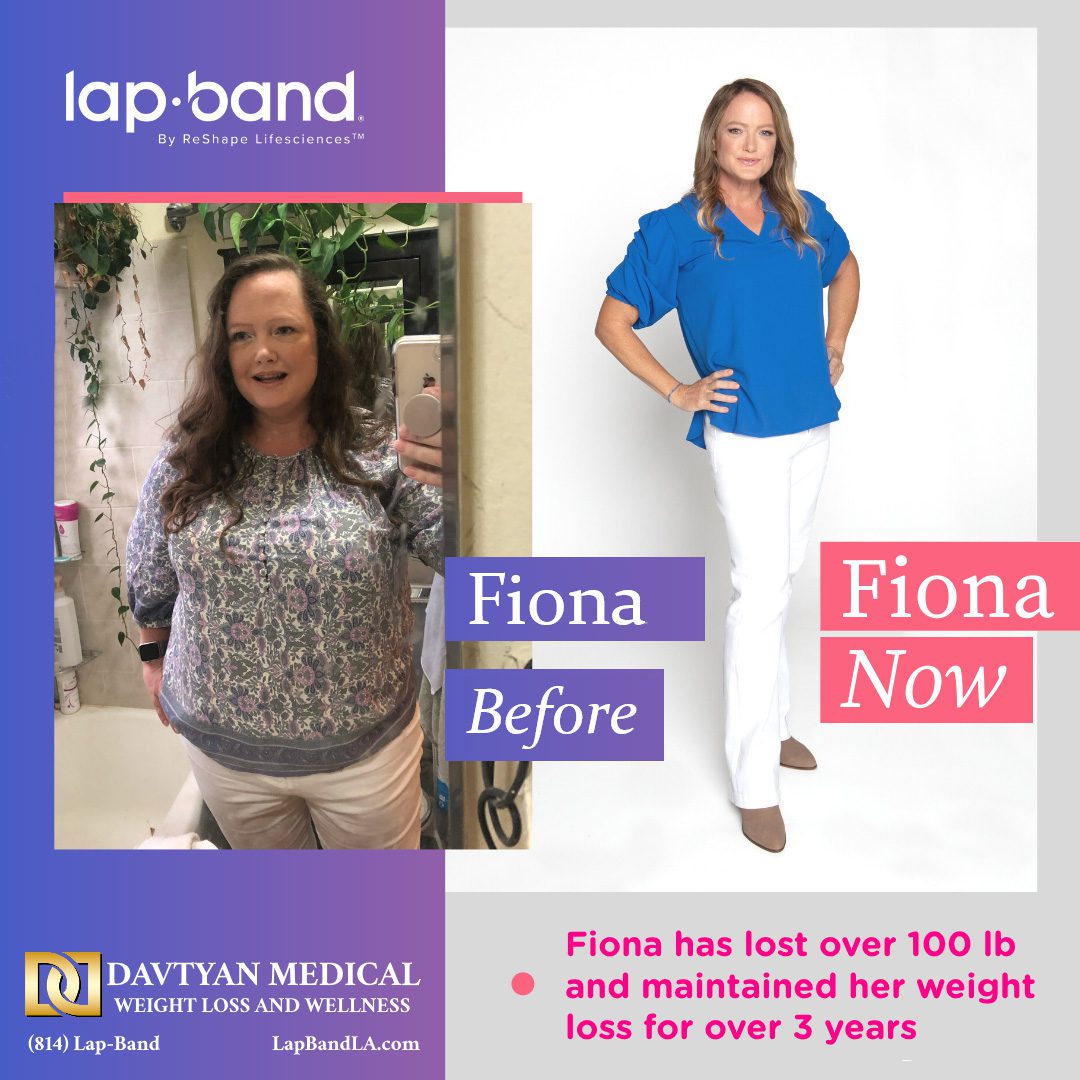 Fiona Before After lapband surgery los angeles
