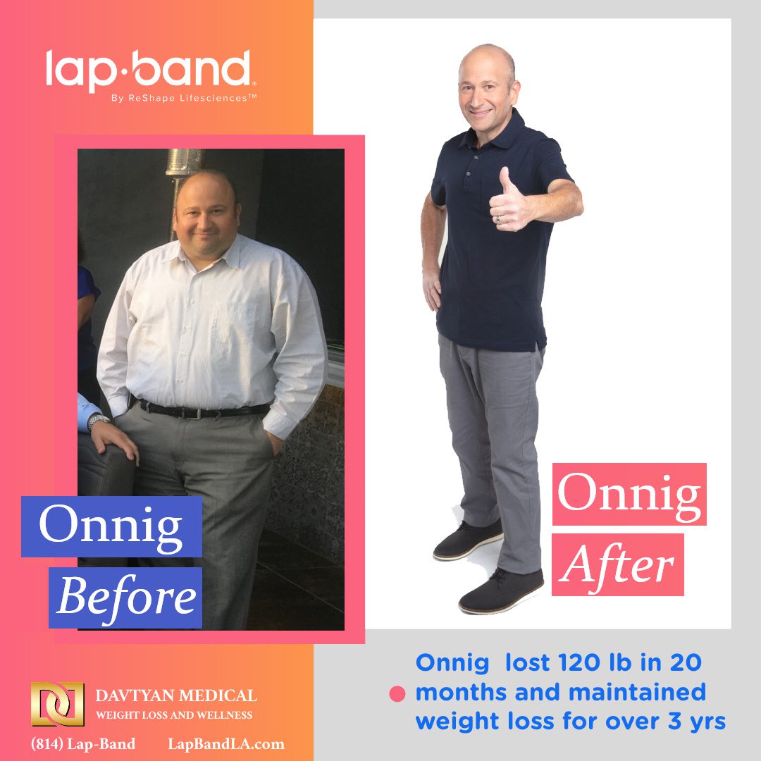 Onnig After Weight Loss Poster weight loss surgery beverly hills