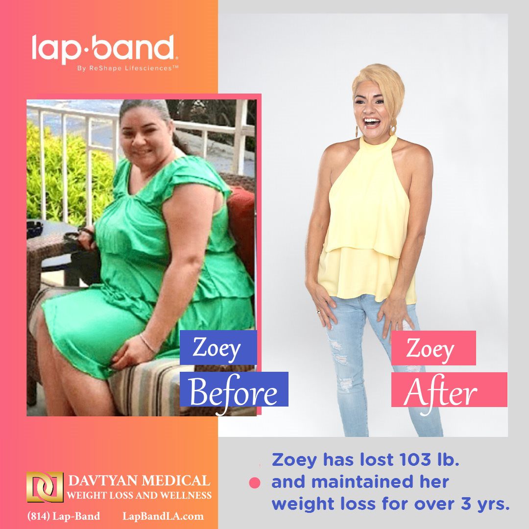 Zoey Before After weight loss surgery